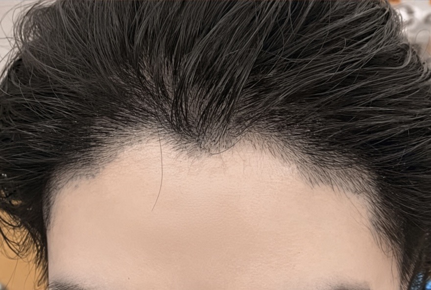 frontal view, Day 7 early healing, not a final result
