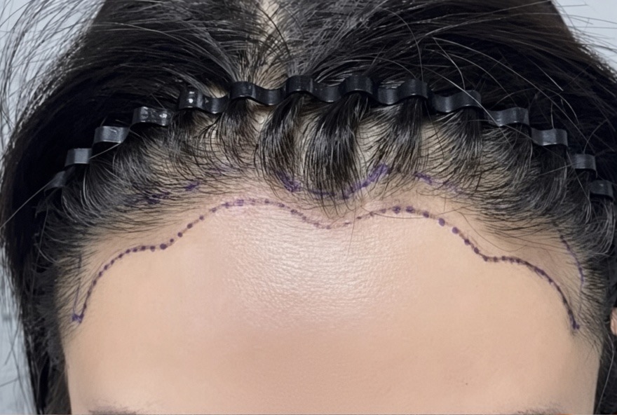 frontal view, before frontal hairline restoration