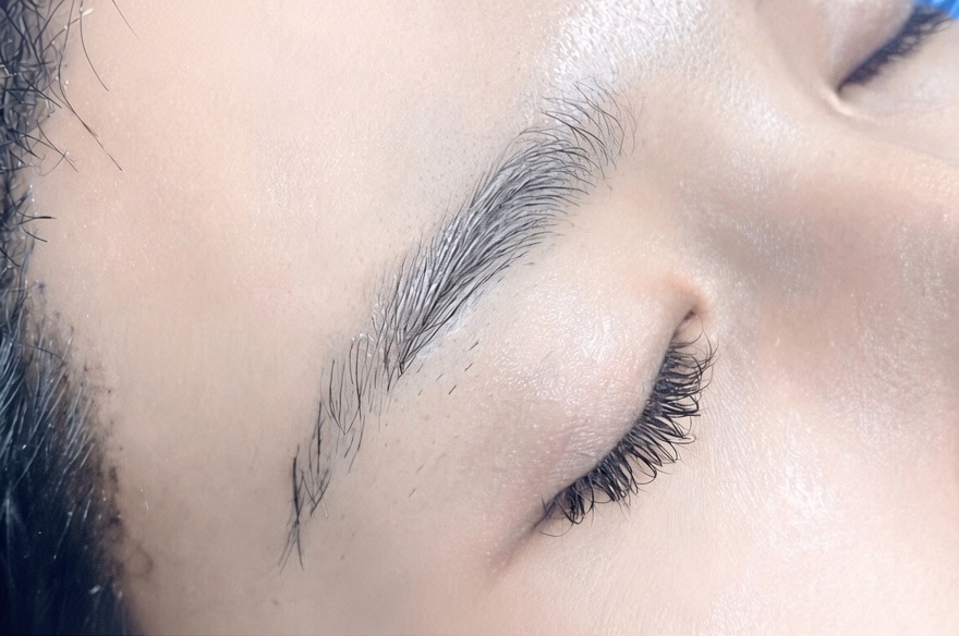 Anatomical right eyebrow, before long-hair FUE eyebrow restoration