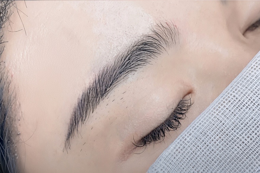 Anatomical right eyebrow, immediate postoperative placement and direction reference, not a final result